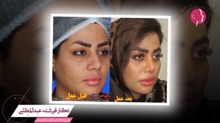 نمونه جراحی بینی