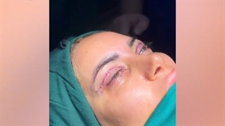 قبل و بعد از جراحی پلک بالا ( بلفاروپلاستی )