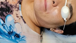 پاک کردن تتو لب با لیزر