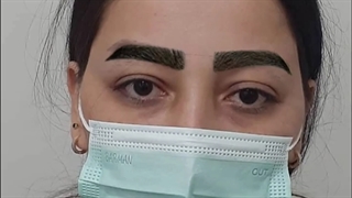 کاشت ابرو با طراحی دلخواه مراجعه کننده عزیز ارتودنسی