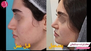نمونه جراحی بینی توسط دکتر عبدالمطلبی