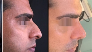 جراحی زیبایی بینی طبیعی و مردانه