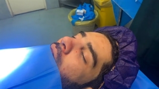 جراحی بینی مردانه و طبیعی