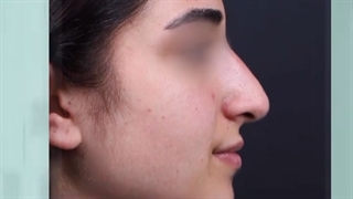 قبل و بعد از جراحی بینی در خانم ۲۴ ساله✨