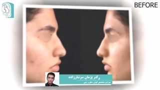 قبل و بعد از جراحی زیبایی بینی