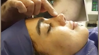 جراحی ترمیمی بینی با پیوند غضروف لاله گوش