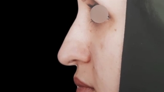 عمل زیبایی بینی