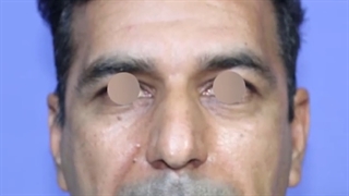 نمونه جراحی بینی آقایان توسط دکتر نظرپور