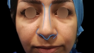 نمونه جراحی بینی توسط دکتر پریسا نظرپور