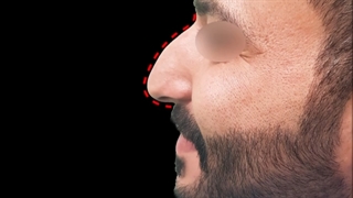 جراحی بینی آقایان