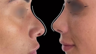 نمونه جراحی بینی دکتر پریسا نظر پور