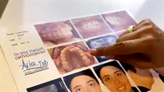 باز کردن سیم دندانها