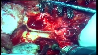 تومور گلوموس ژوگولار چیست؟