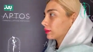 تزریق فیلر چانه و گونه