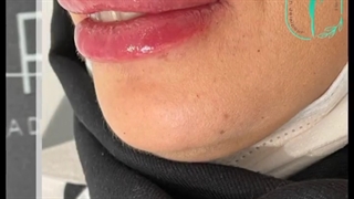اصلاح و فرم دهی لب ها برای زیباجوی عزیزمون با تزریق ژل
