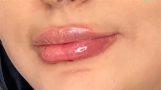 تزریق ژل لب