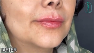 تاثیر ژل لب در زیبایی