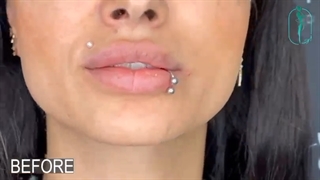 اصلاح و فرم دهی لب ها برای زیباجوی عزیزمون با تزریق ژل