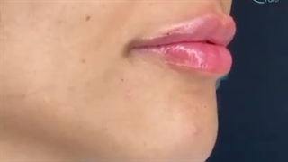 اصلاح لبخند لثه ای با تزریق فیلر