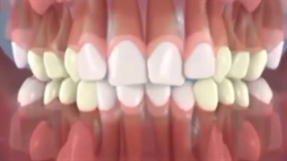 انیمیشن صاف شدن دندان ها