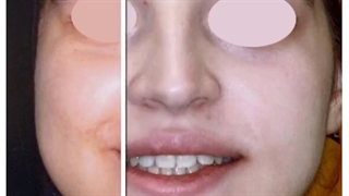 نمونه ارتودنسی توسط دکتر نگار حدادی پلاسماجت