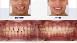 نمونه ارتودنسی دکتر نگار حدادی درمان جای جوش