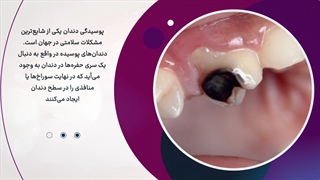 پوسیدگی دندان چیست