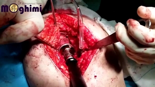 عمل جراحی تعویض مفصل ران