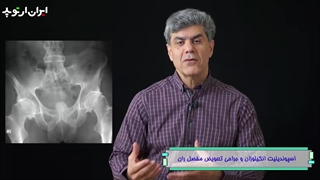 اسپوندیلیت انکیلوزان لگن و درمان آن