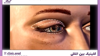 برداشتن پف چشم