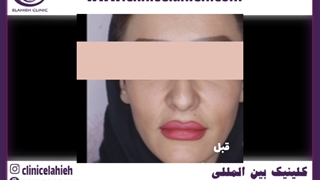تزریق چربی