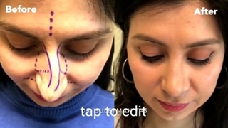 فیلم واقعی ترمیم بینی