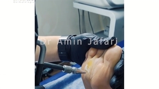 لیزر زگیل hpv