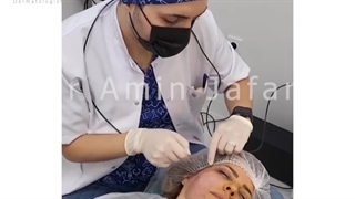 اندولیفت صورت