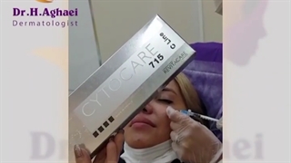 تزریق مزوژل ۷۱۵ رویتاکر جهت رفع تیرگی دور چشم