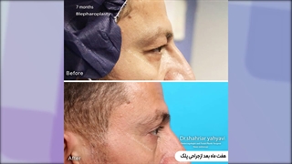 هفت ماه پس از جراحی افتادگی پلک