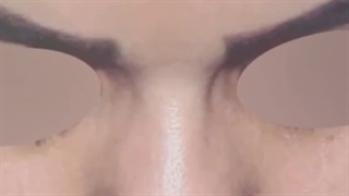 نمونه جراحی بینی گوشتی