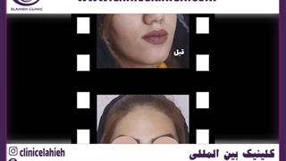 تزریق چربی به بینی