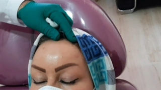 بوتاکس پیشانی و لیفتینگ ابرو در کلینیک پوست امیدوار