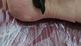 زالو درمانی