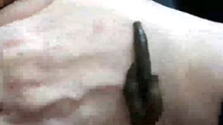 زالودرمانی