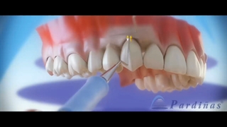 چرا لثه تحلیل می رود؟ | درمان اینجاست...