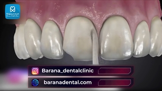 کامپوزیت شکسته چگونه ترمیم میشود؟