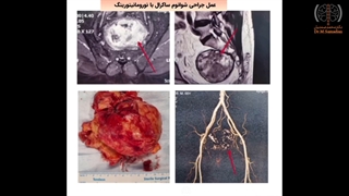 عمل جراحی شوانوم ساکرال با نورومانیتورینگ