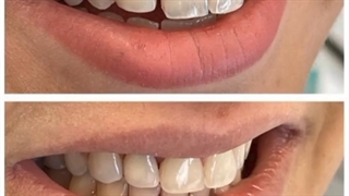 اصلاح طرح لبخند