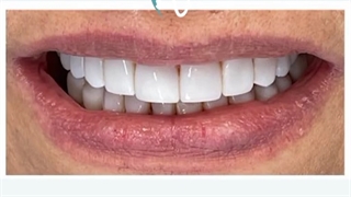 اصلاح طرح لبخند