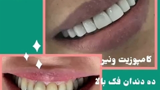 کامپوزیت ونیر ده دندان فک بالا با رنگ صدفی