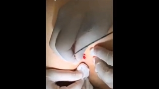 فیلم عمل کیست مویی با لیزر در پرتو کلینیک - Partoclinic.com