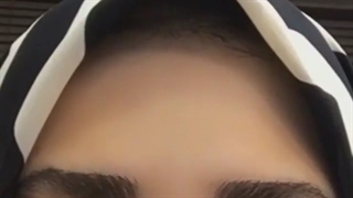 بوتاکس پیشانی در کلینیک خانه امیدوار