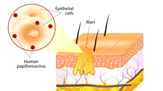 دکتر زگیل تناسلی در تهران